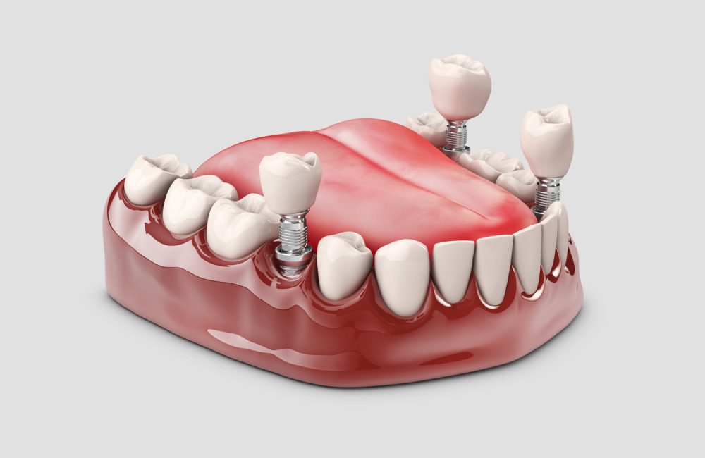 Human teeth and Dental implant. 3d illustration.